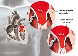 Plastie de la valve mitrale - Cardiologie et sport